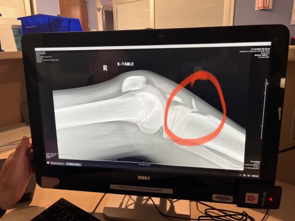 The x-ray of Johnson’s injury